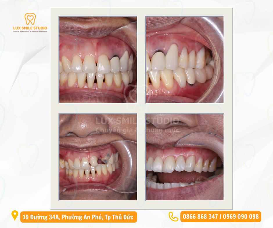 Implant thẩm mỹ