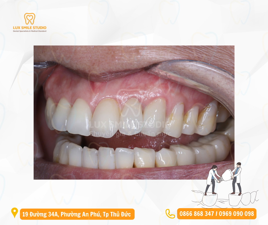 Implant thẩm mỹ