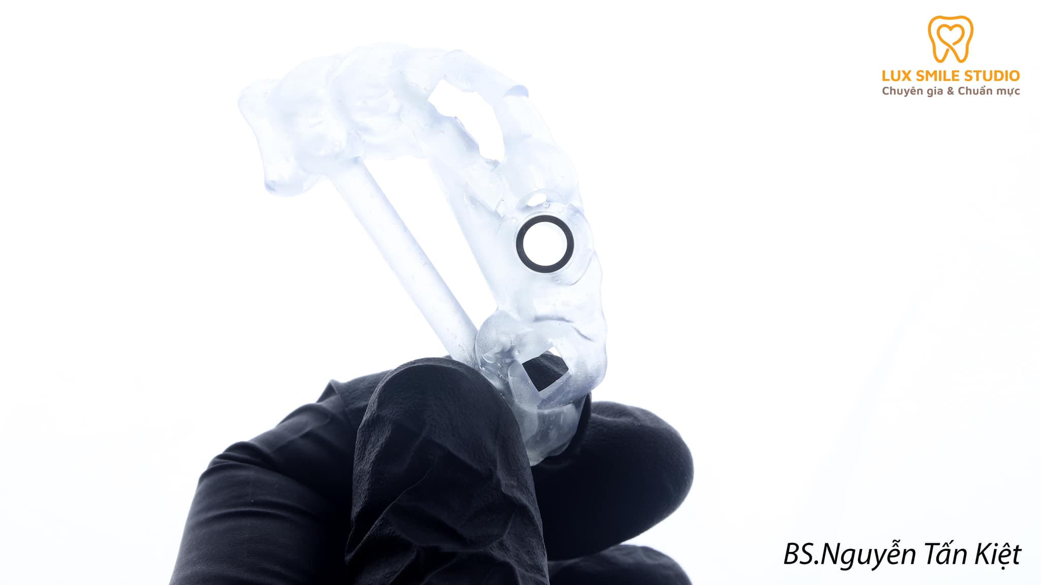 Implant răng cửa