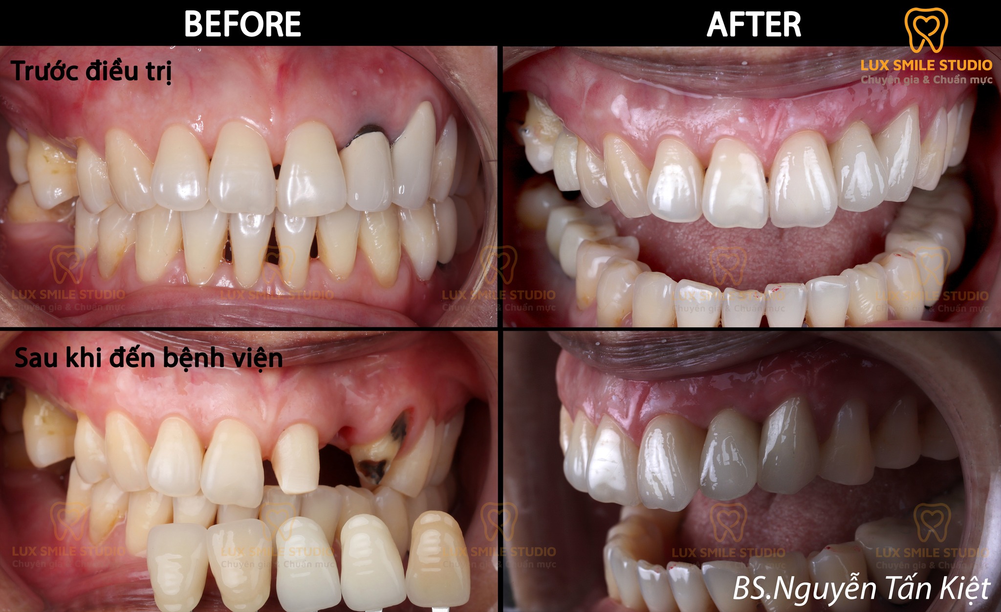 IMPLANT RĂNG CỬA