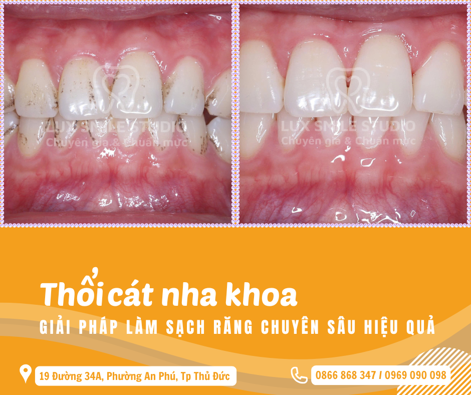 Thổi cát nha khoa