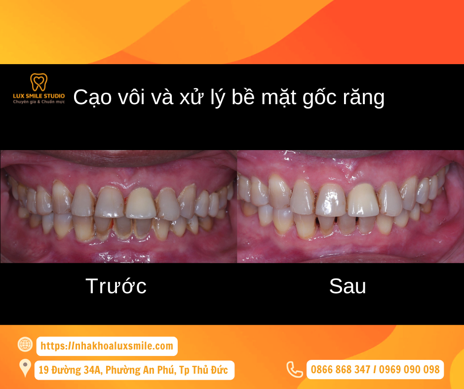 Quy trình CVR siêu âm