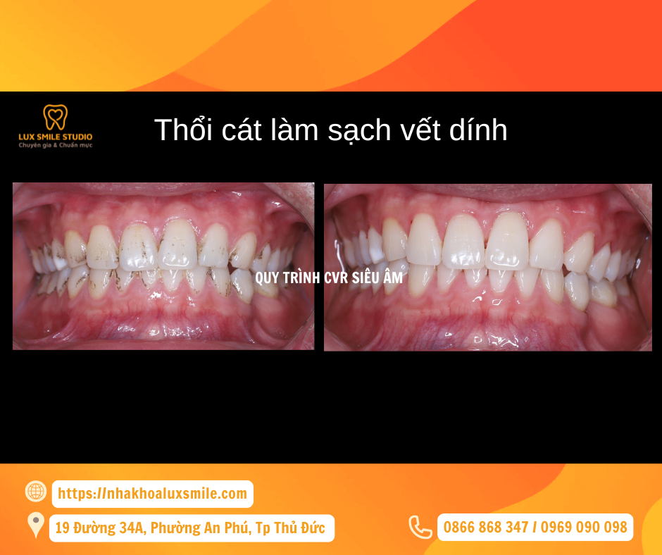 Quy trình CVR siêu âm