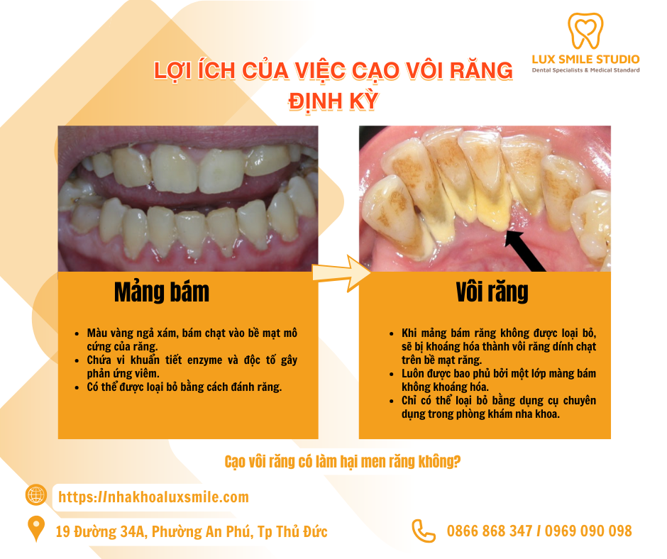 Cạo vôi răng