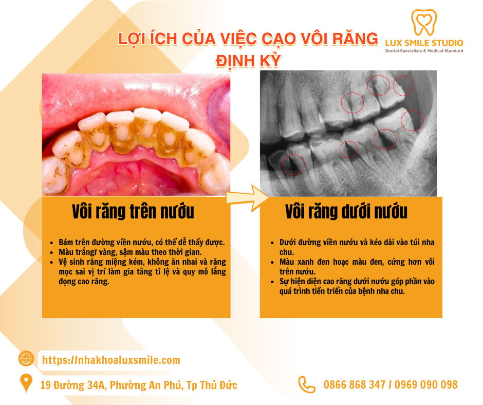 Cạo vôi răng