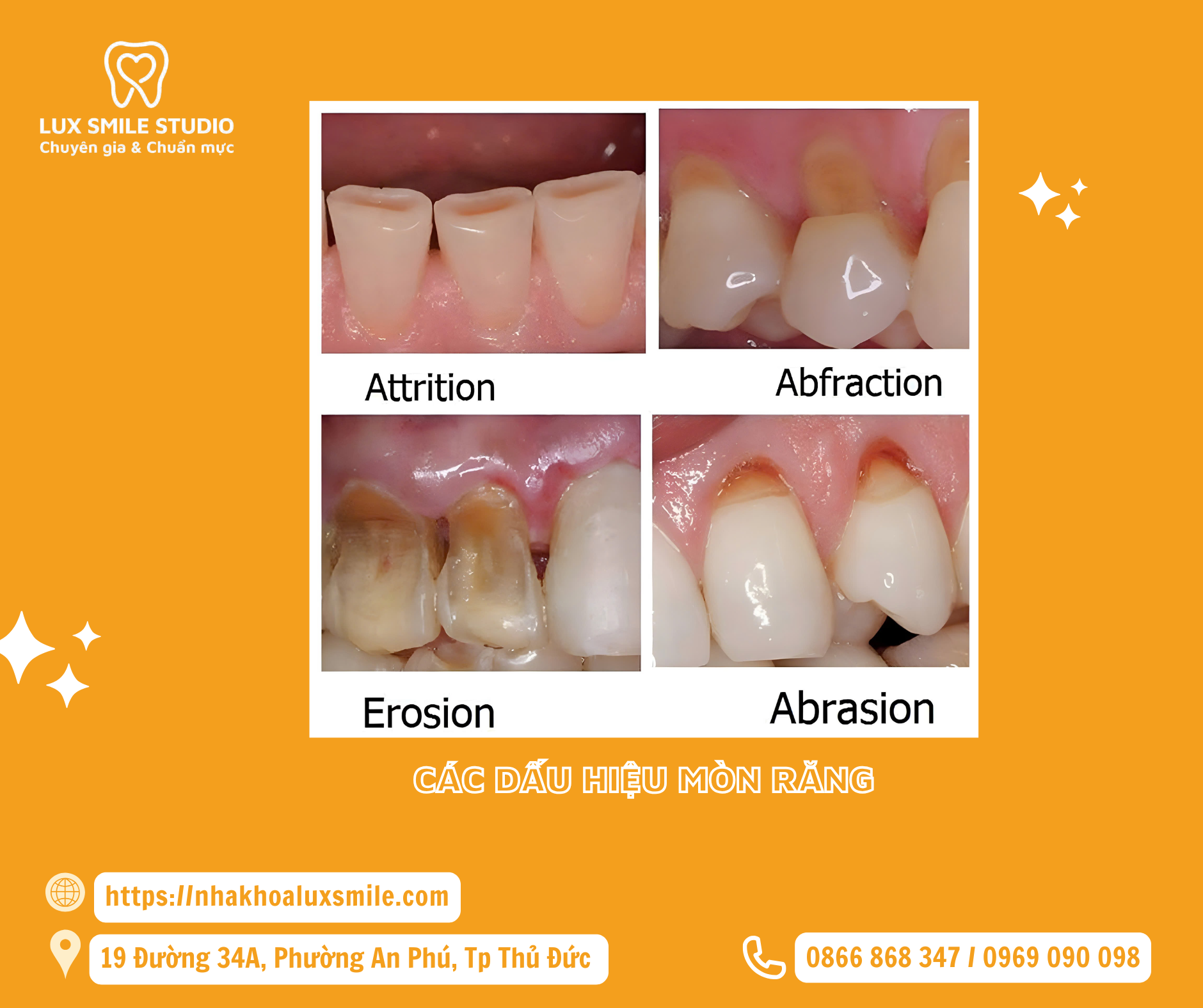 Phục hồi mòn răng bằng composite