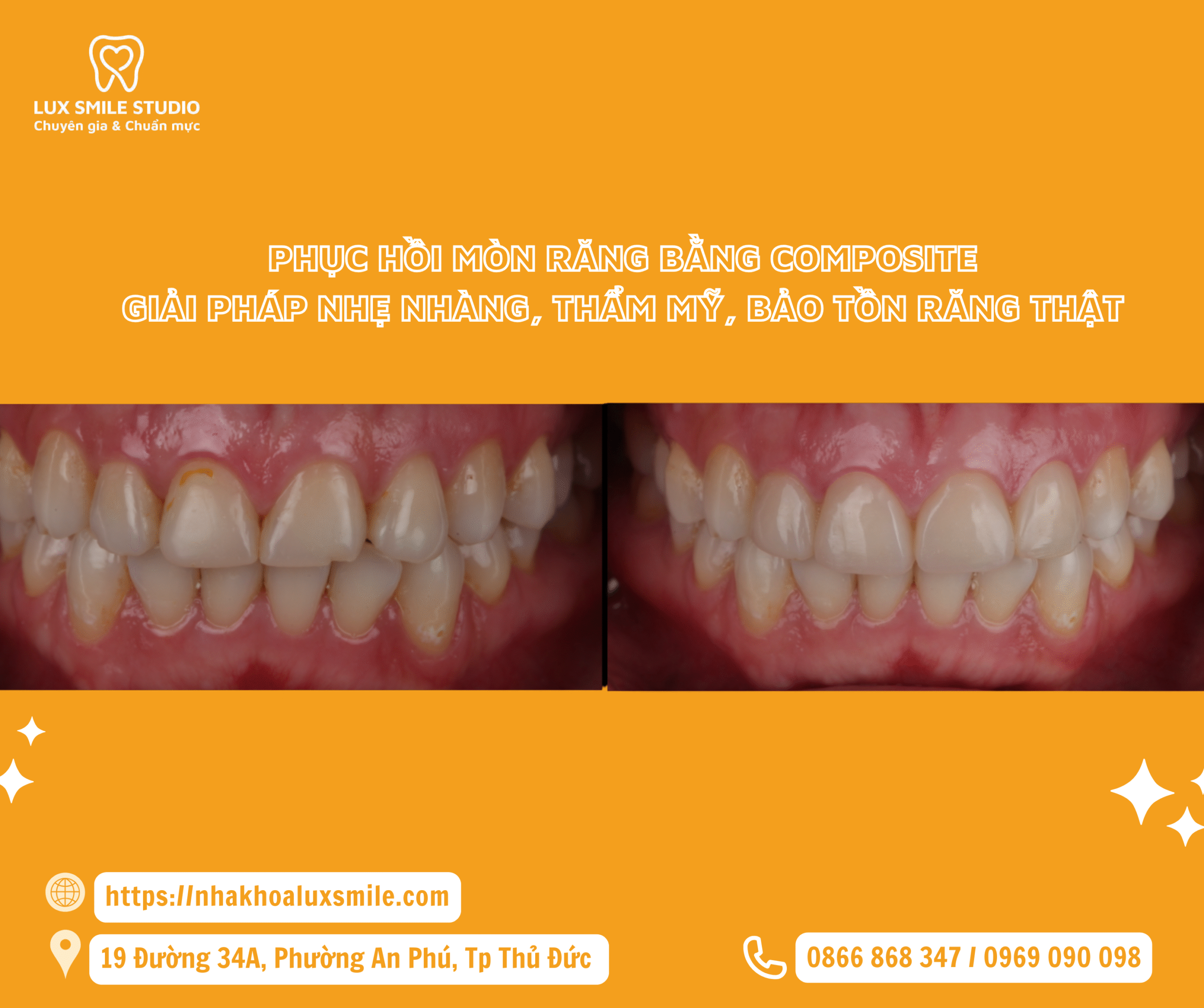 Phục hồi mòn răng bằng composite