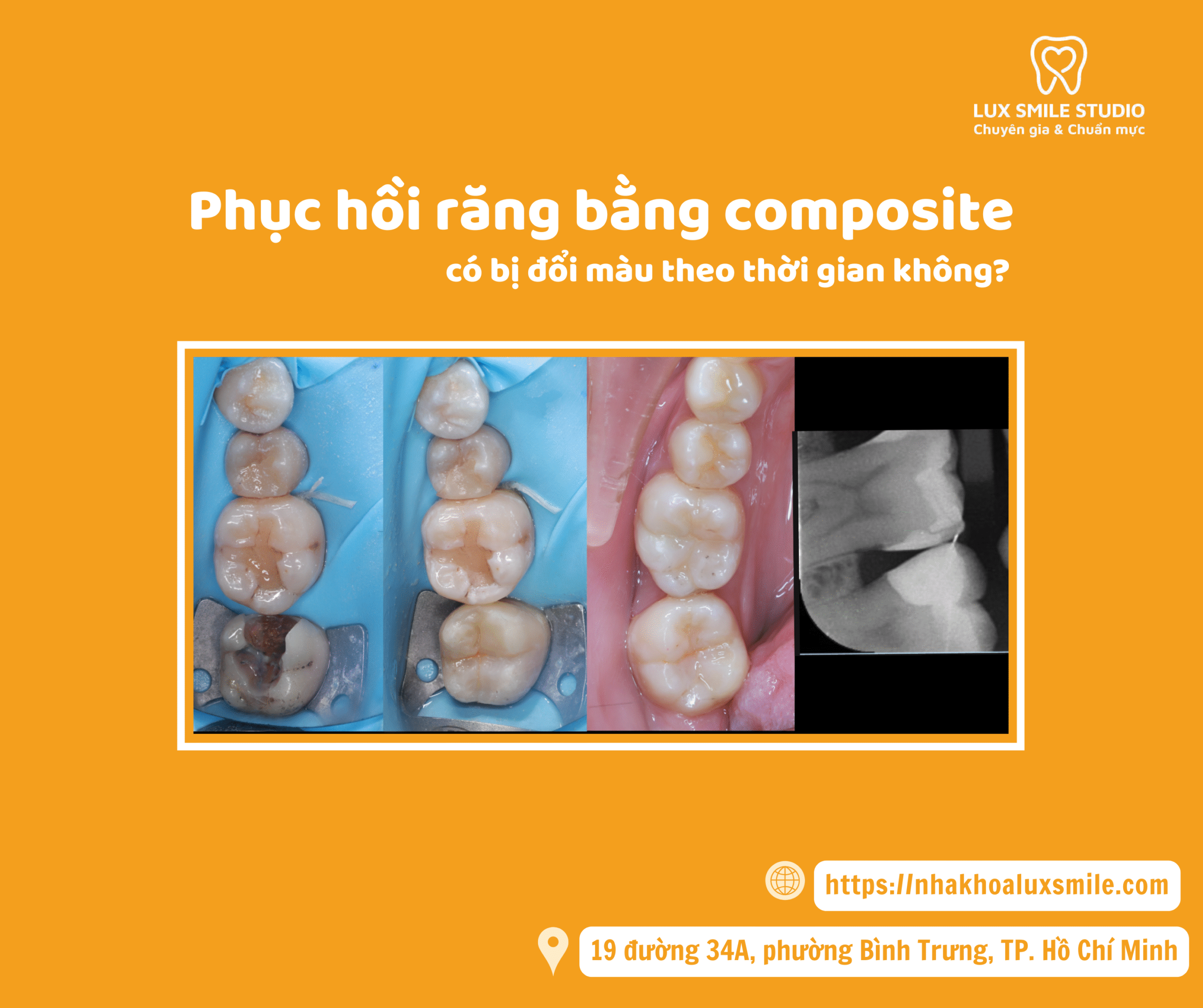 Phục hồi răng bằng composite có bị đổi màu theo thời gian không?