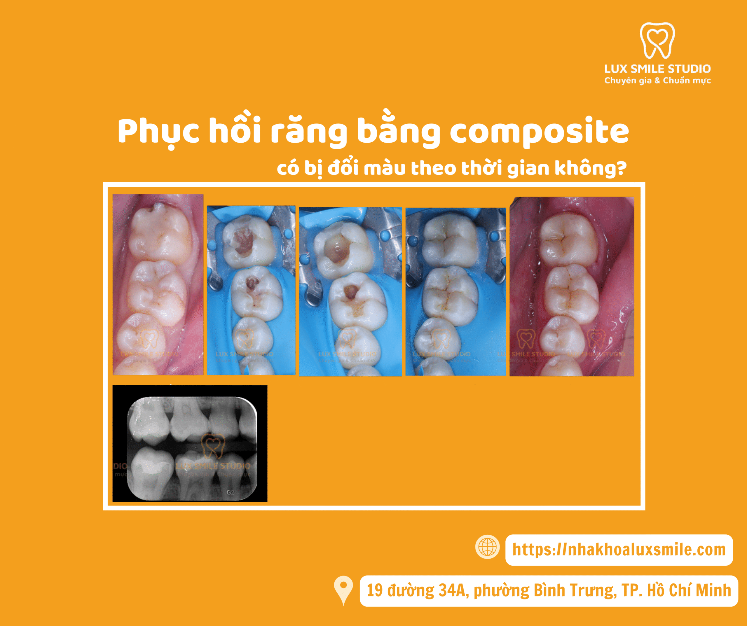 Phục hồi răng bằng composite có bị đổi màu theo thời gian không?