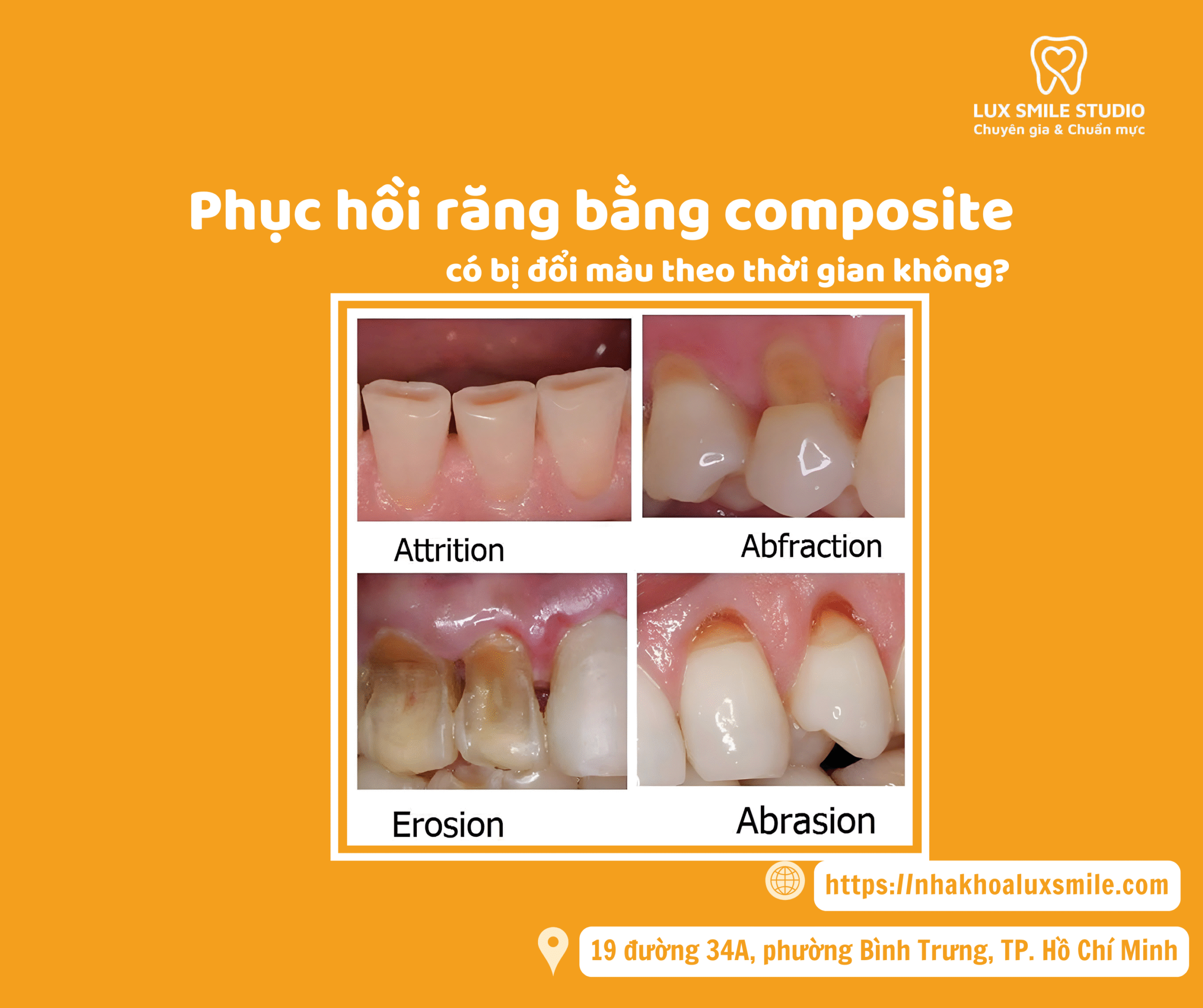 Phục hồi răng bằng composite có bị đổi màu theo thời gian không?