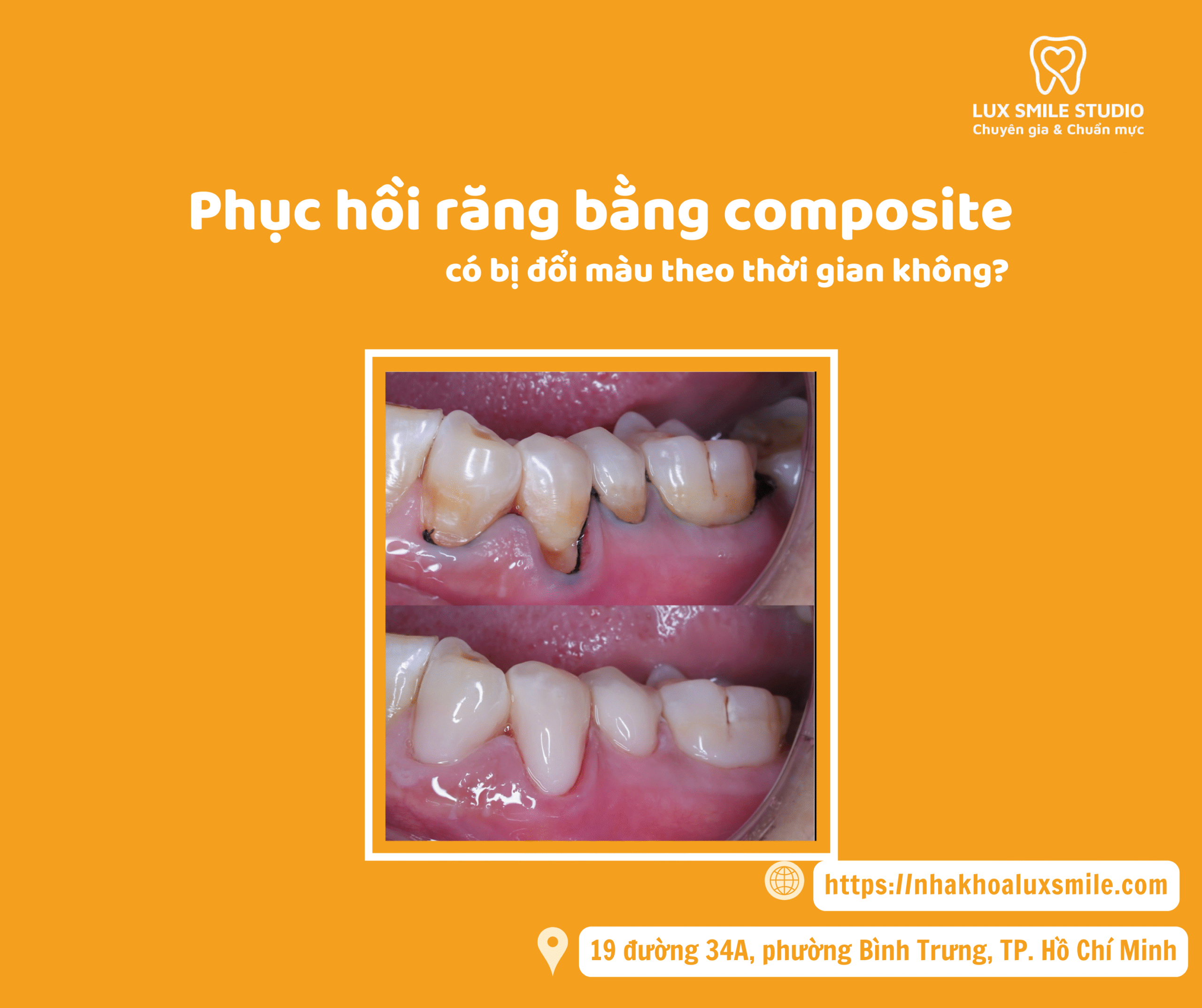 Phục hồi răng bằng composite có bị đổi màu theo thời gian không?