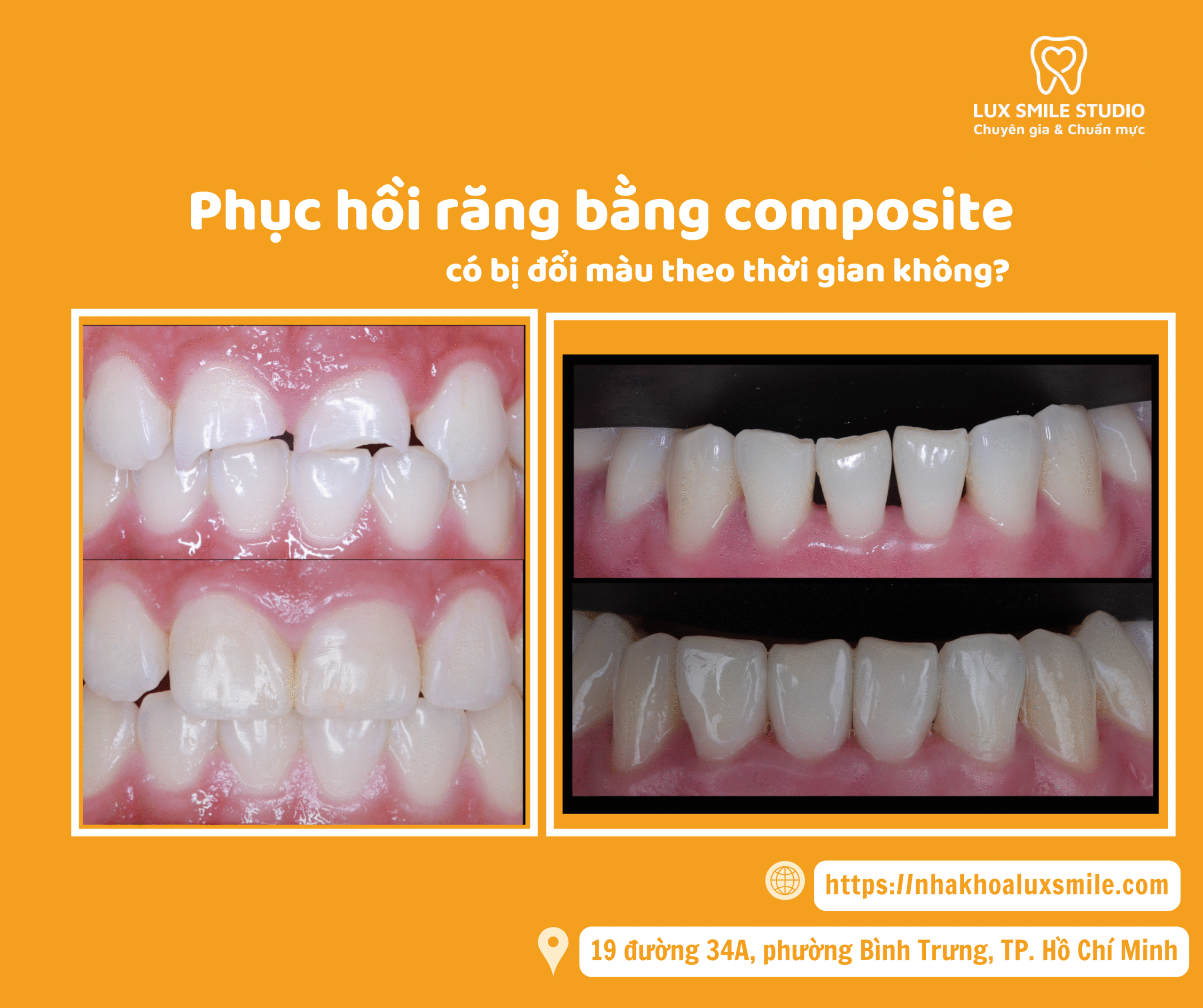 Phục hồi răng bằng composite có bị đổi màu theo thời gian không?