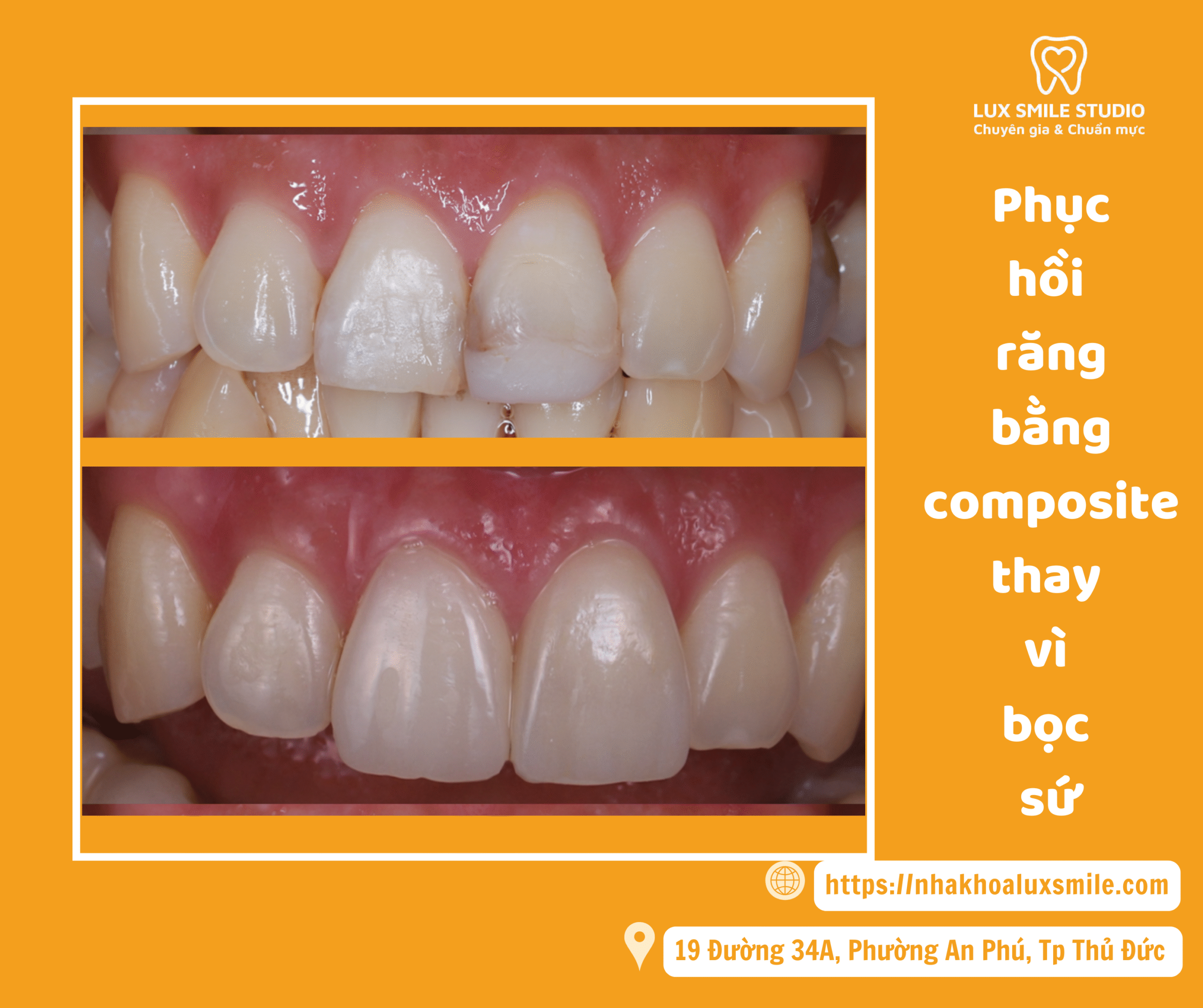 Phục hồi răng bằng composite thay vì bọc sứ