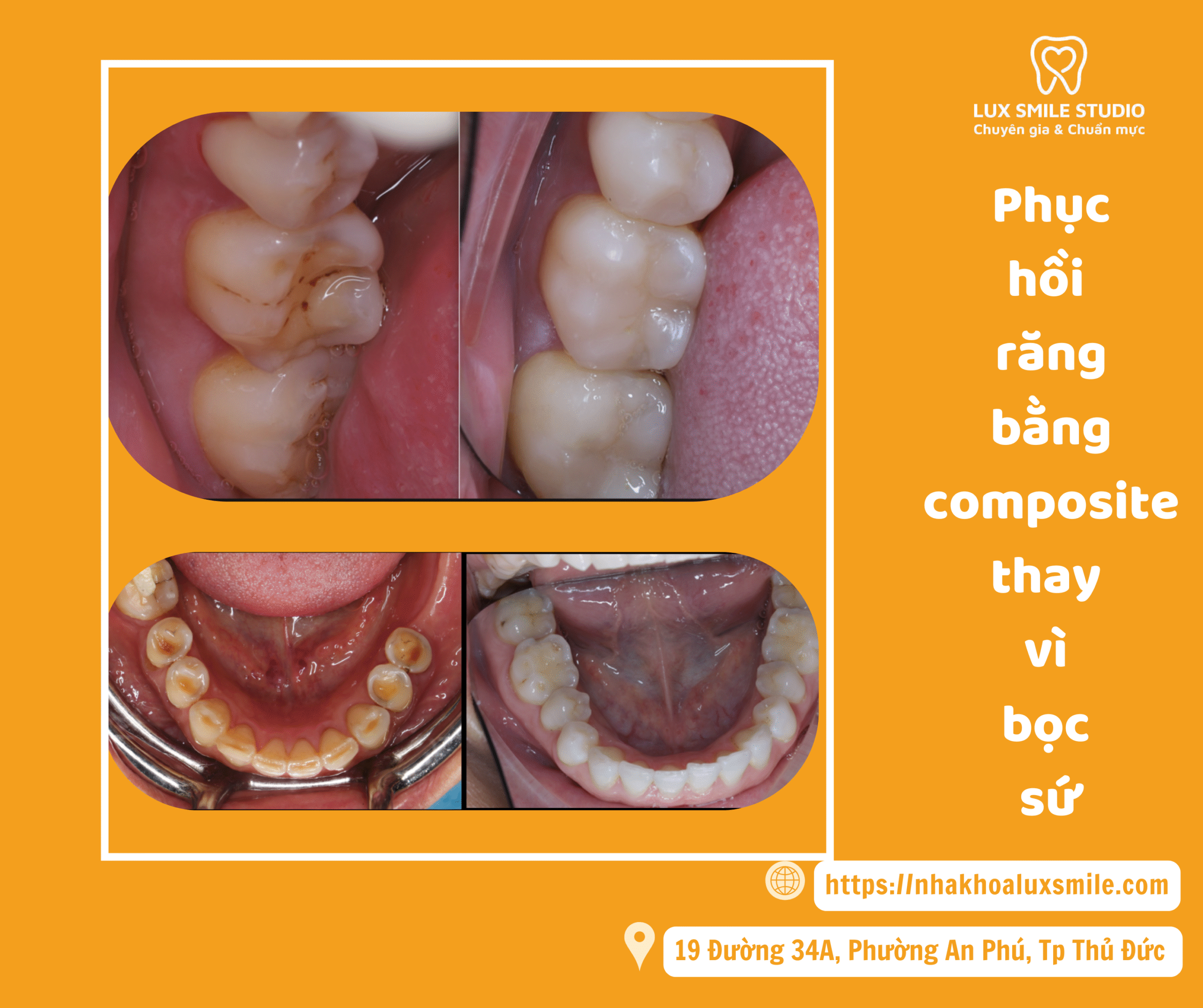 Phục hồi răng bằng composite thay vì bọc sứ