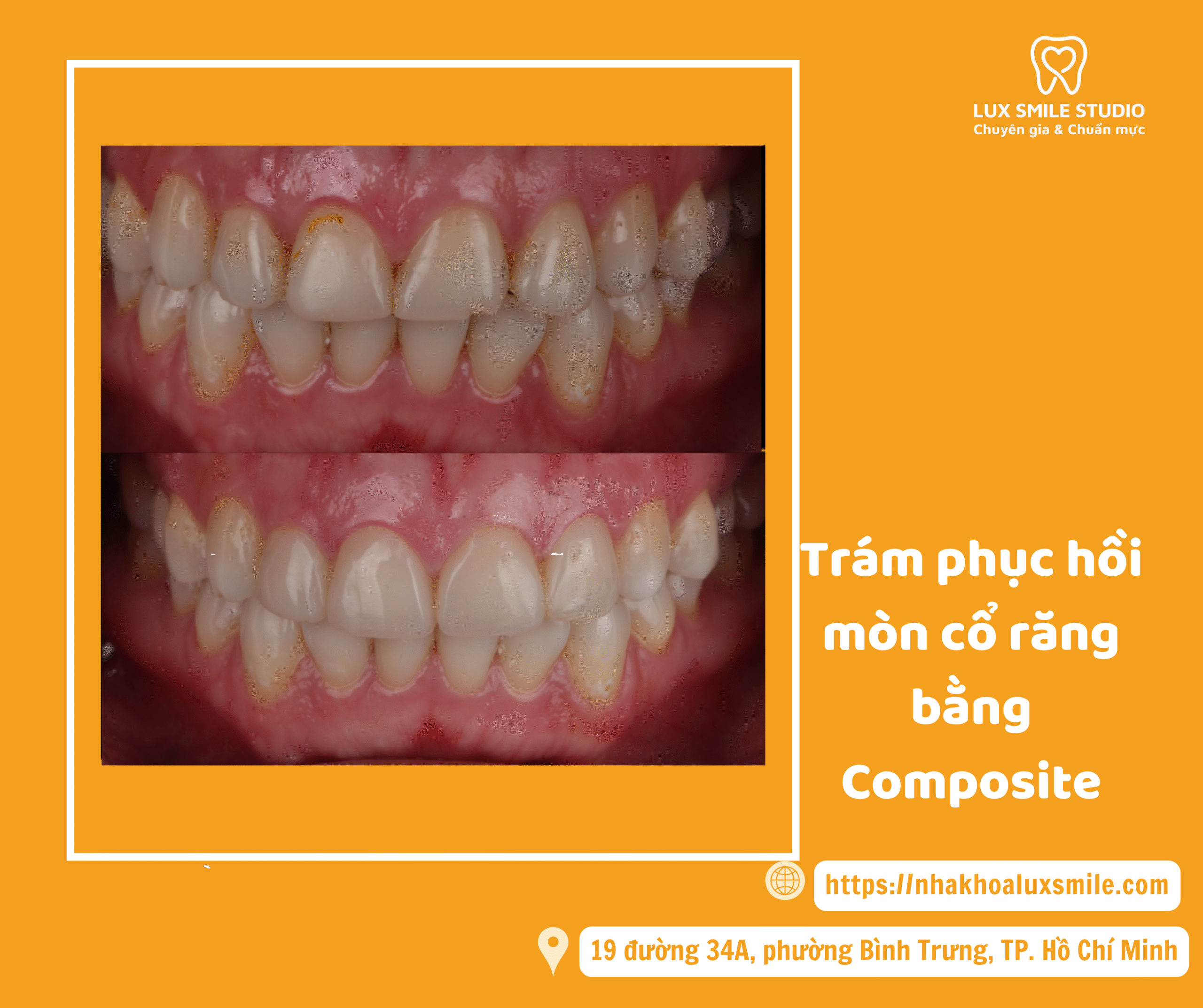 Trám phục hồi mòn cổ răng bằng Composite