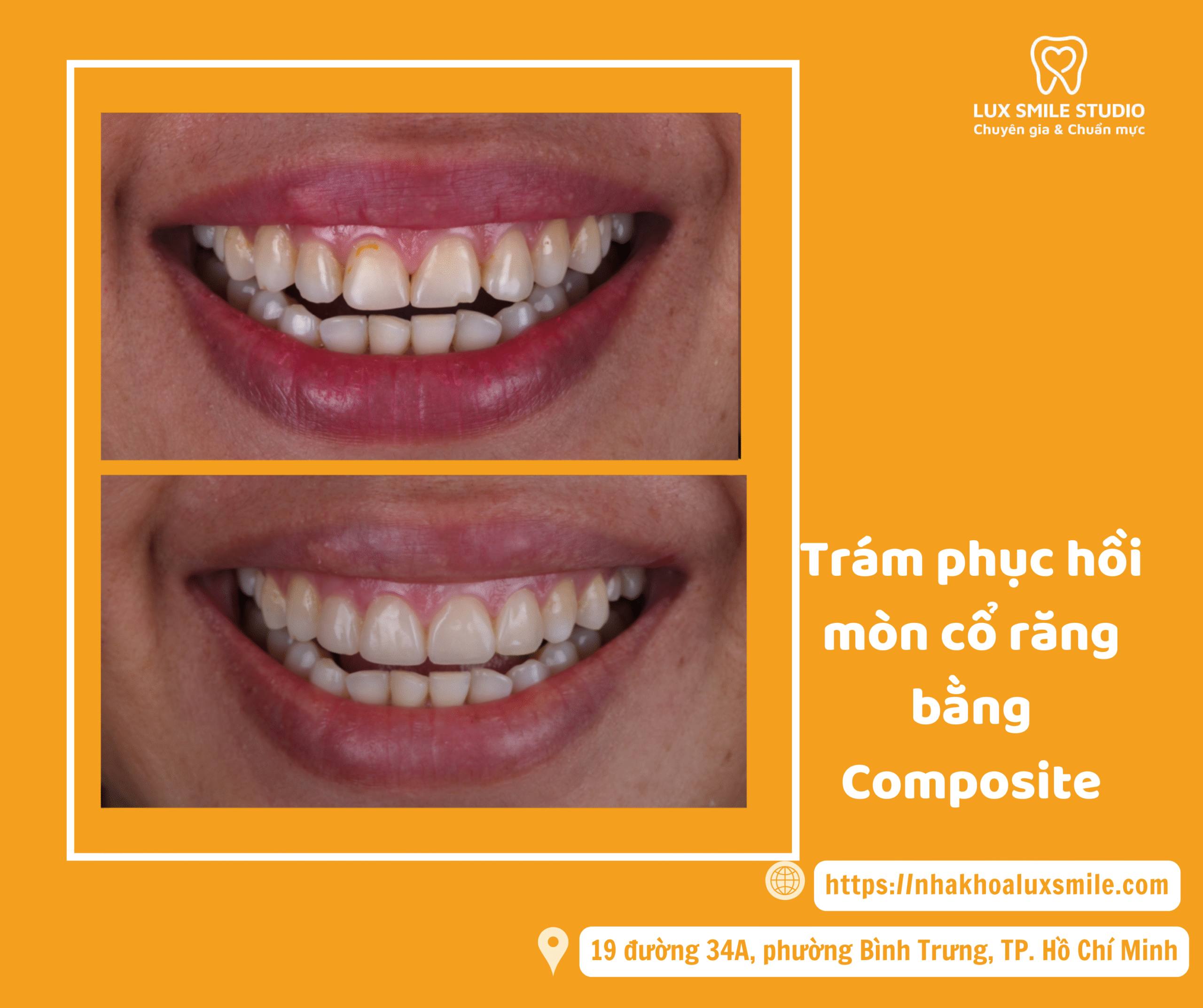 Trám phục hồi mòn cổ răng bằng Composite