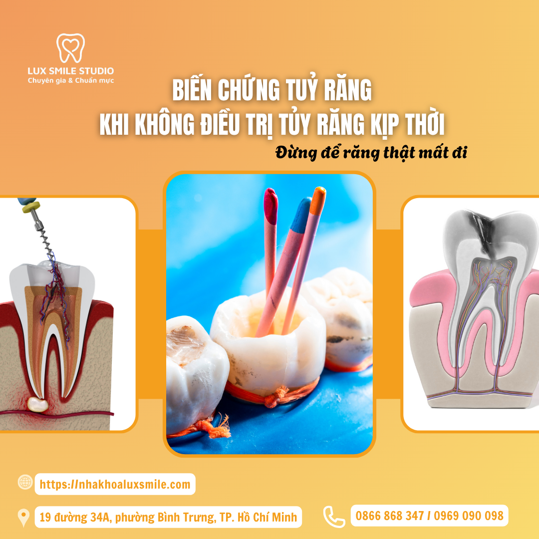 Biến chứng tuỷ răng khi không điều trị tủy răng kịp thời – Đừng để răng thật mất đi