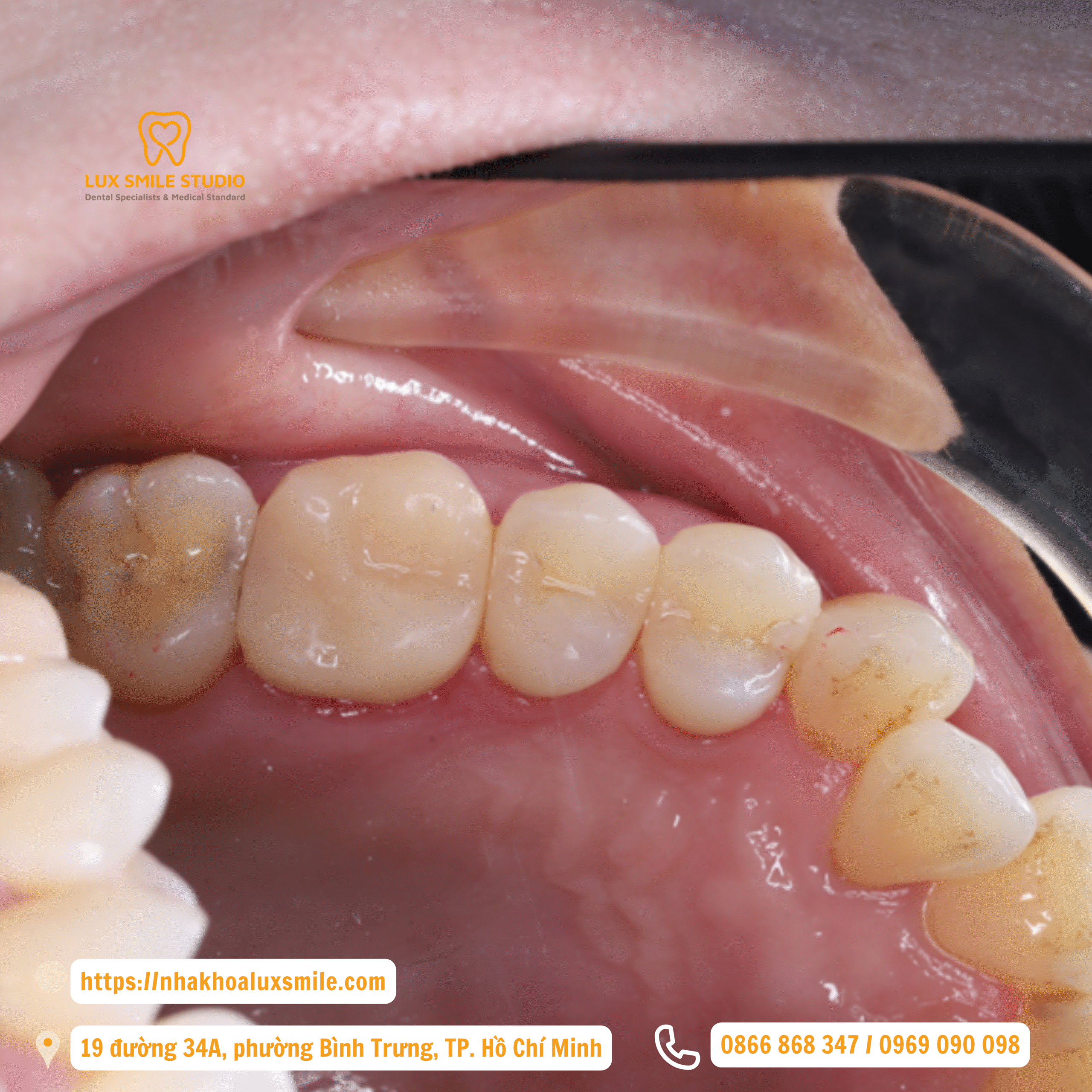 Phục hồi răng sau điều trị tủy