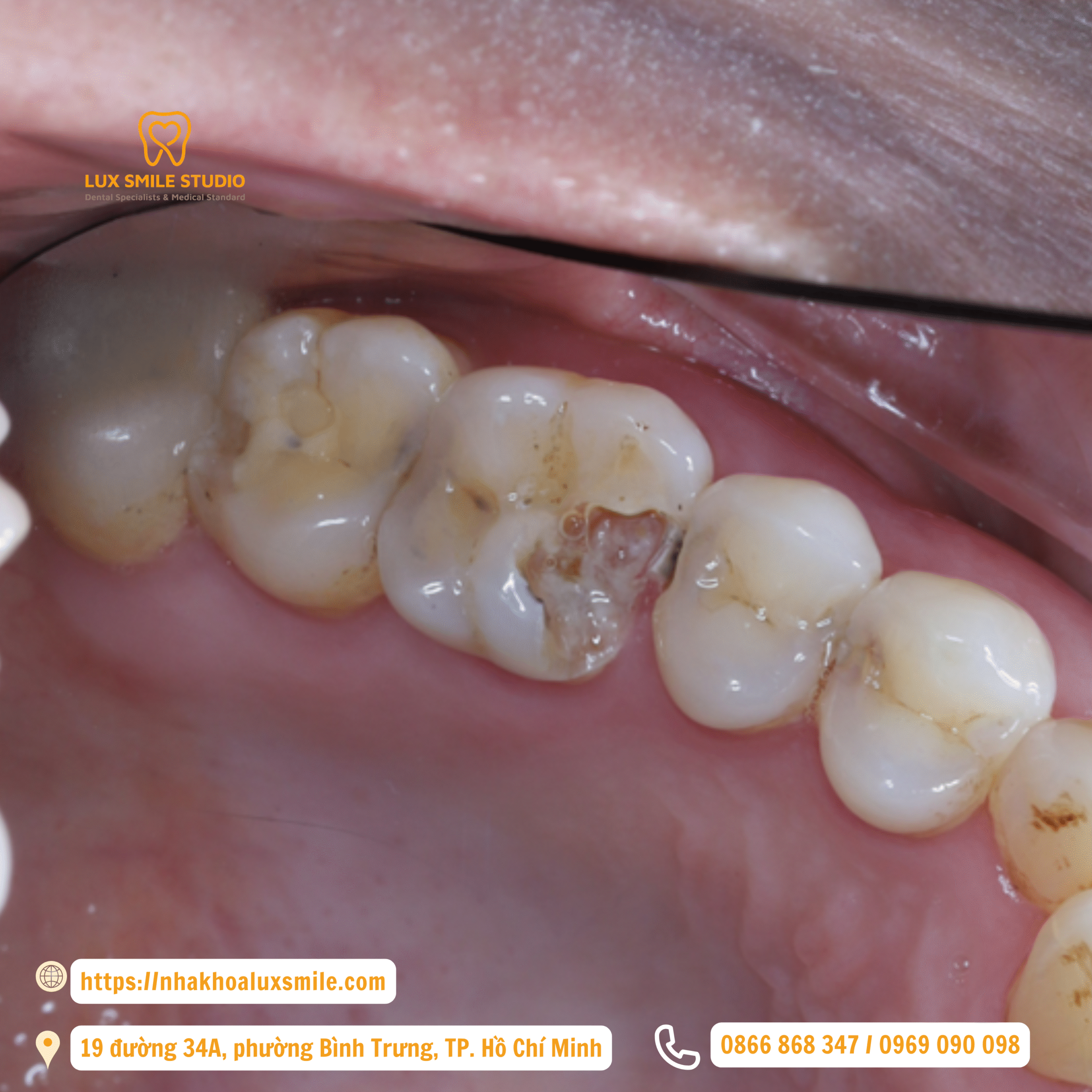 Phục hồi răng sau điều trị tủy