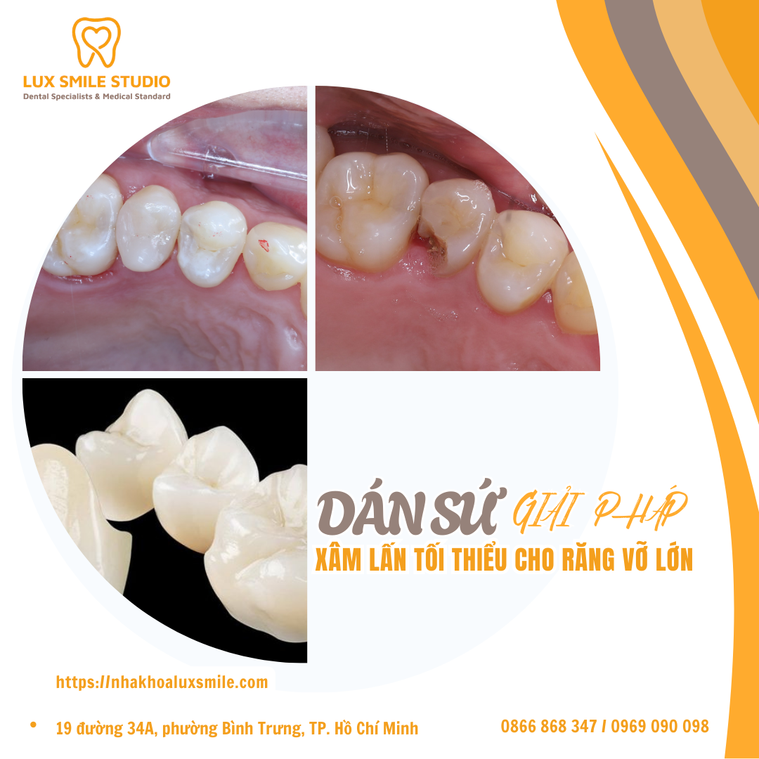 Dán sứ