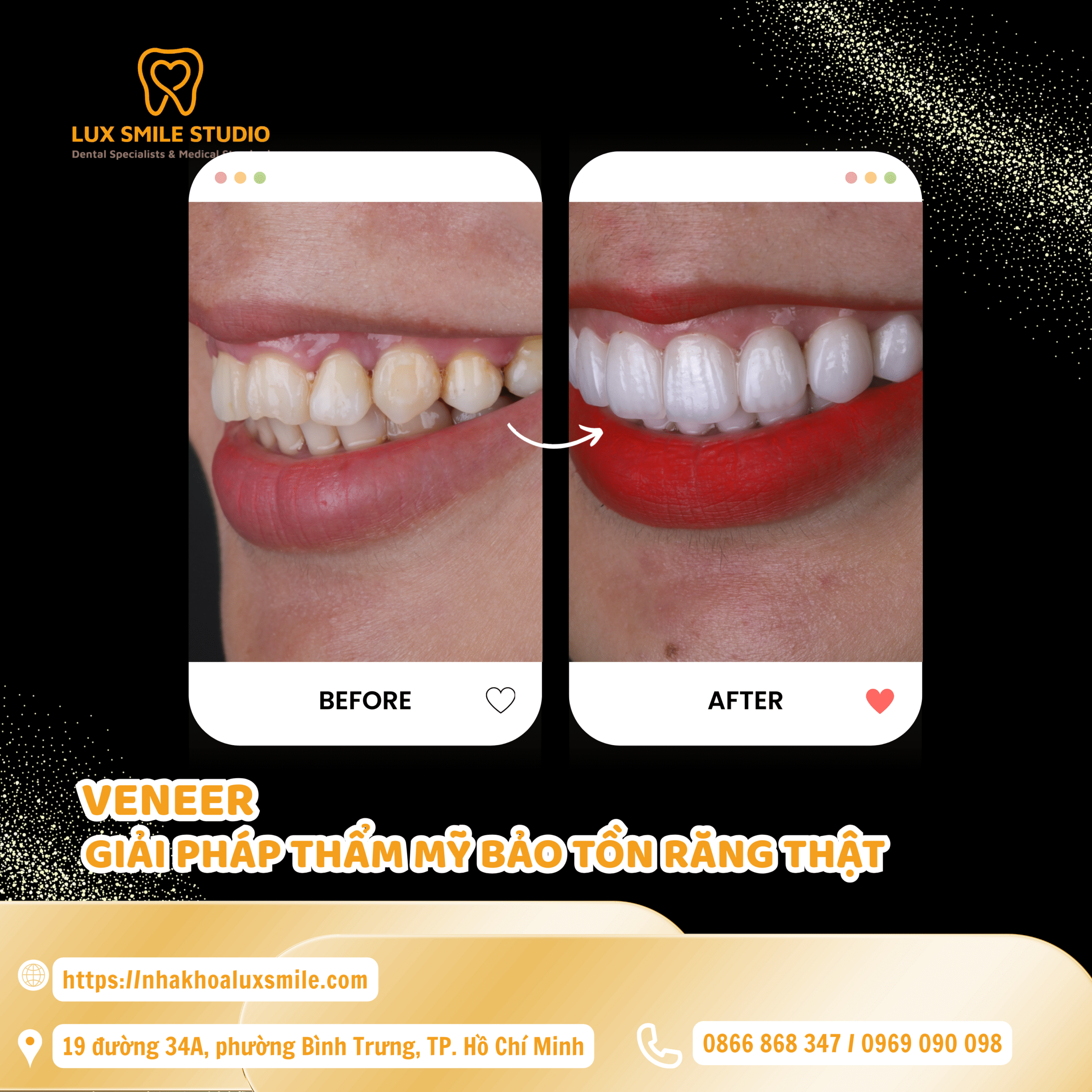Dán sứ Veneer có tốt không? Góc nhìn từ chuyên gia 