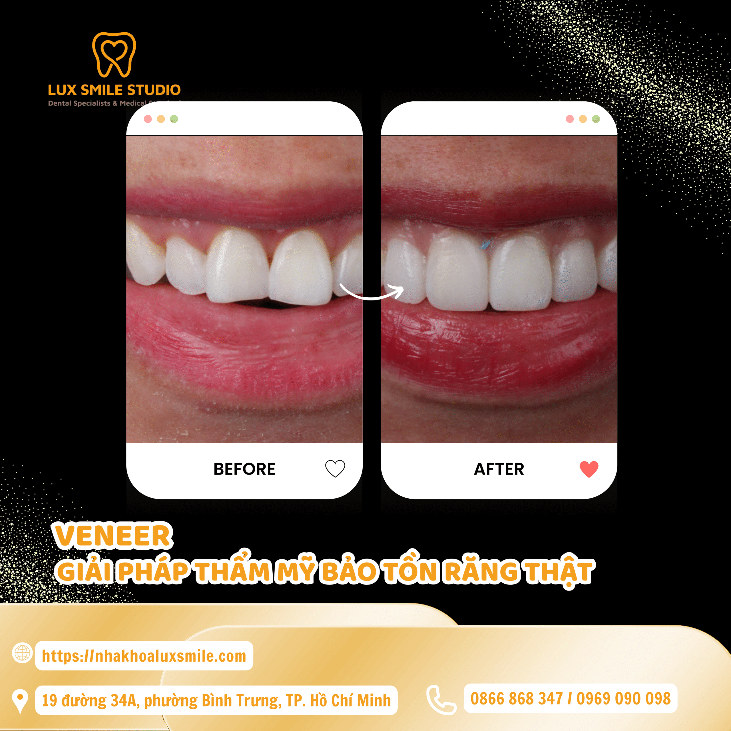 Dán sứ Veneer