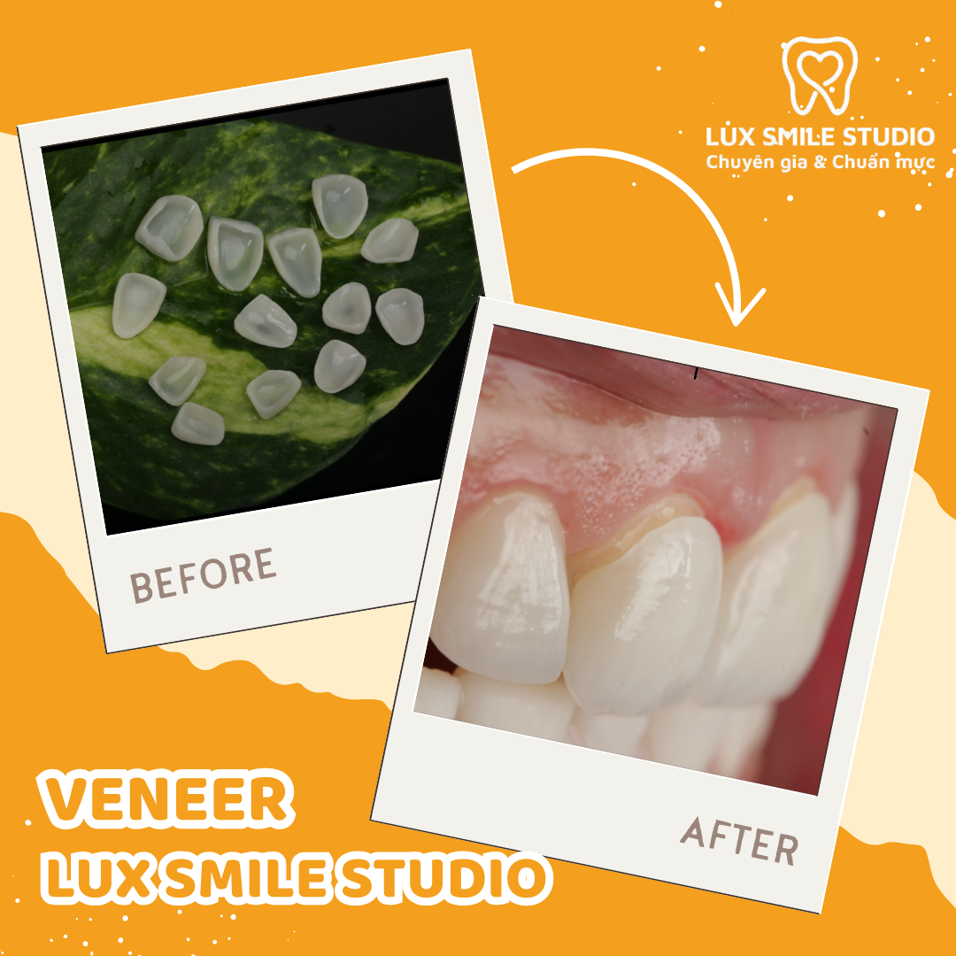 Dán sứ Veneer