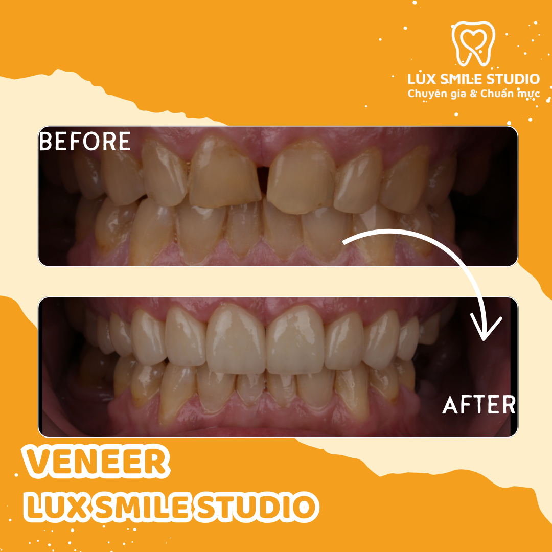 Dán sứ Veneer