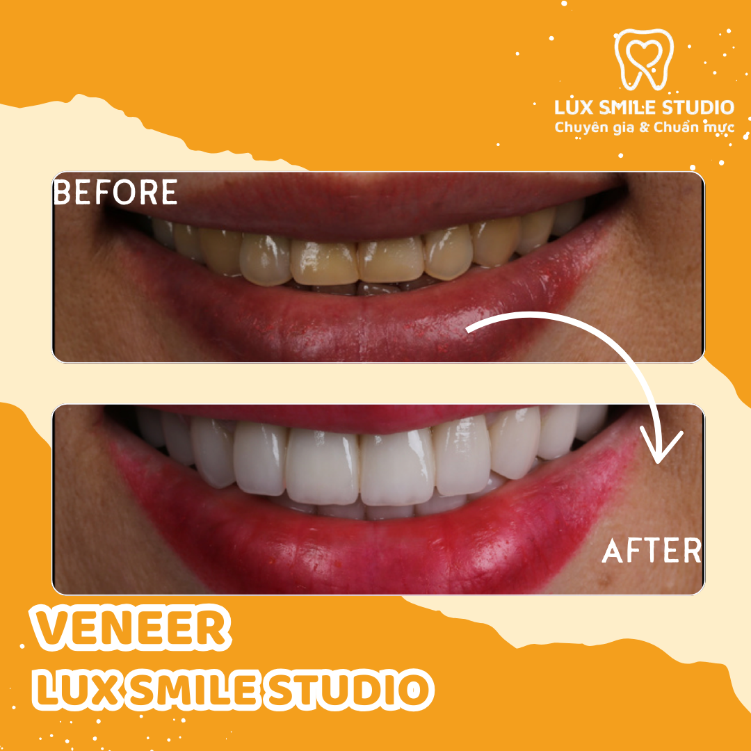 Dán sứ Veneer