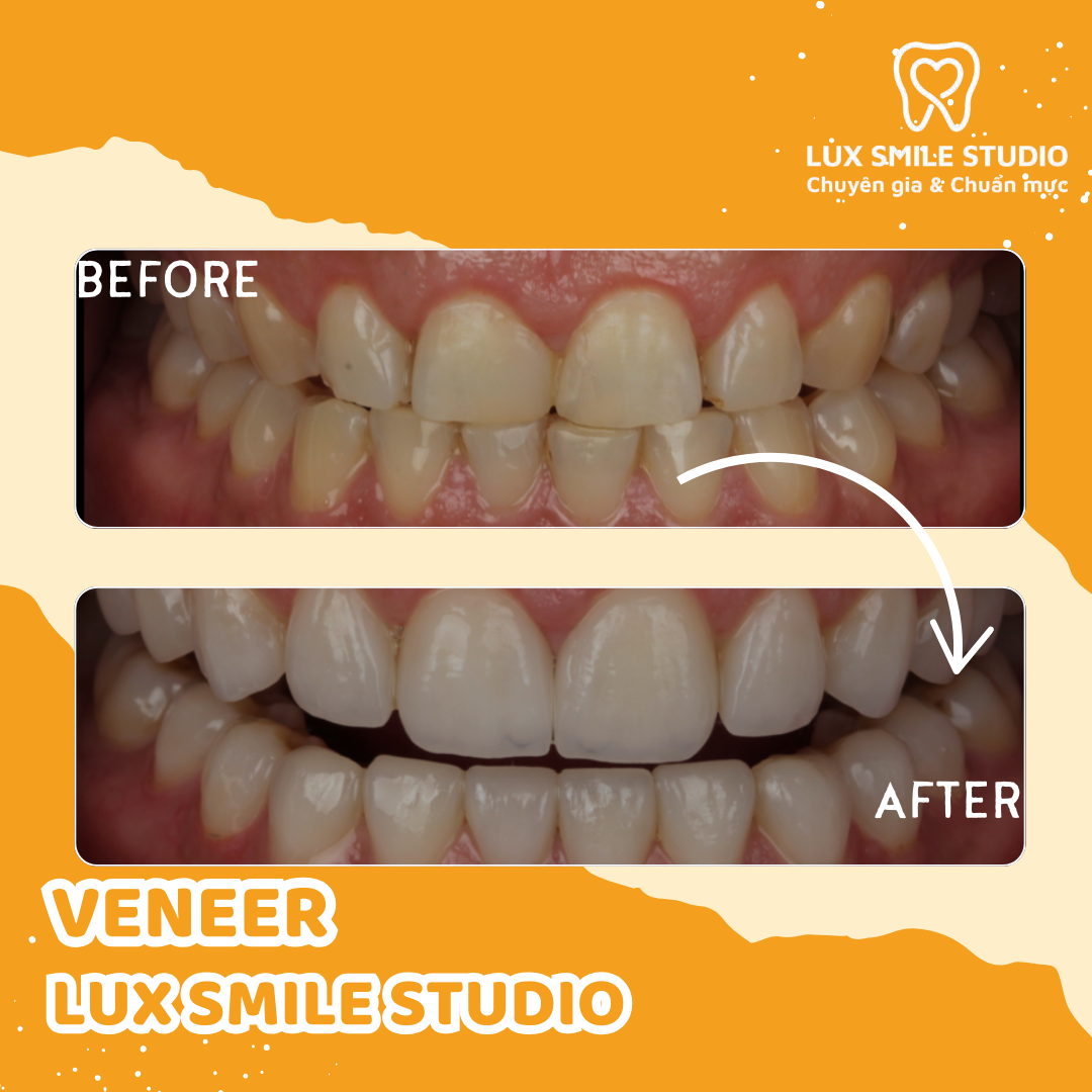 Dán sứ Veneer