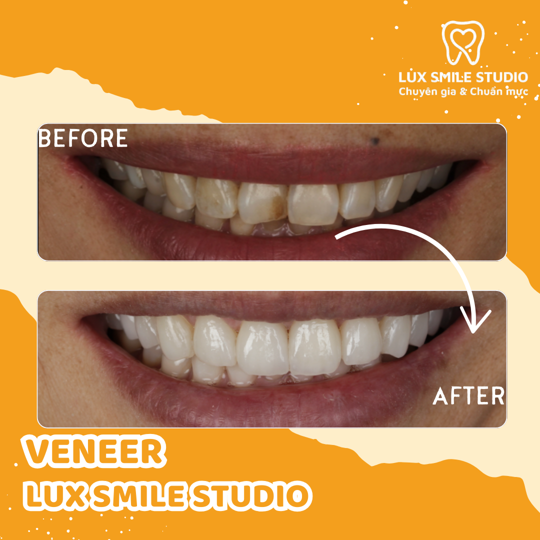 Dán sứ Veneer