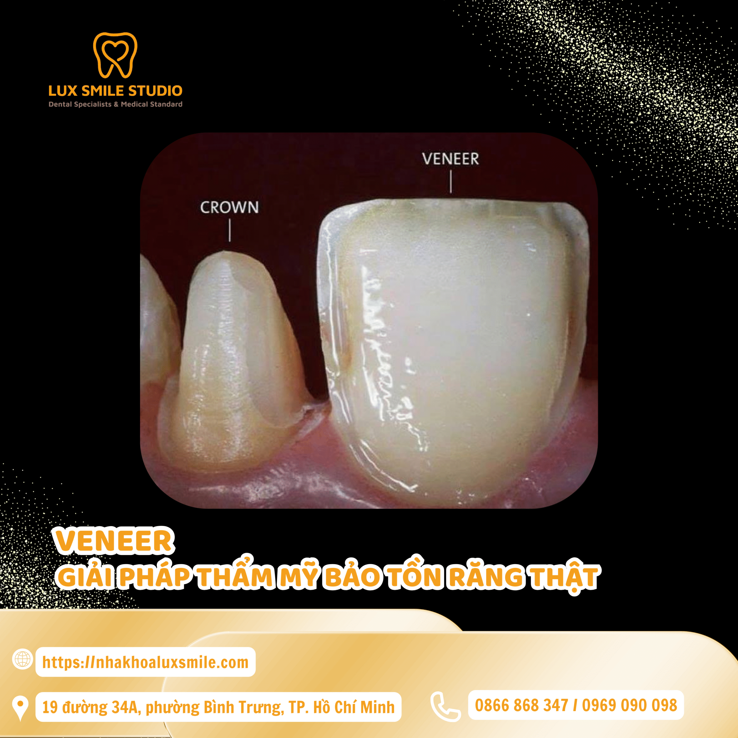 Dán sứ Veneer