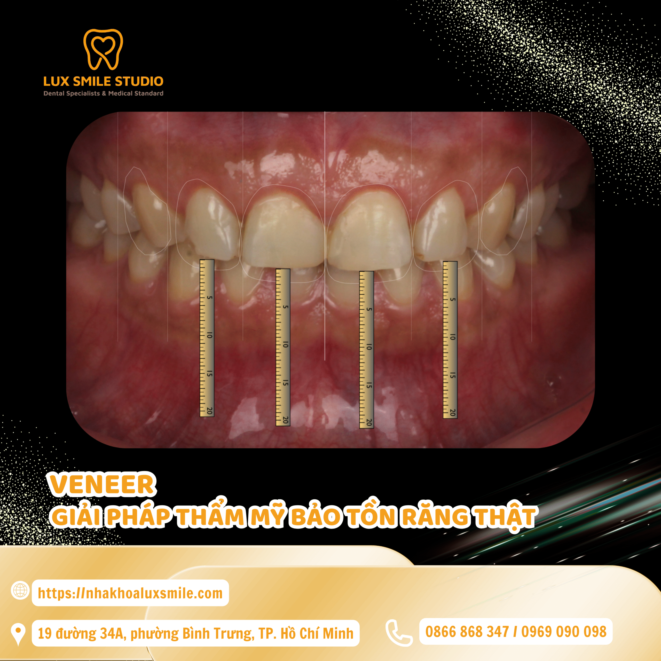 Dán sứ Veneer có tốt không? Góc nhìn từ chuyên gia
