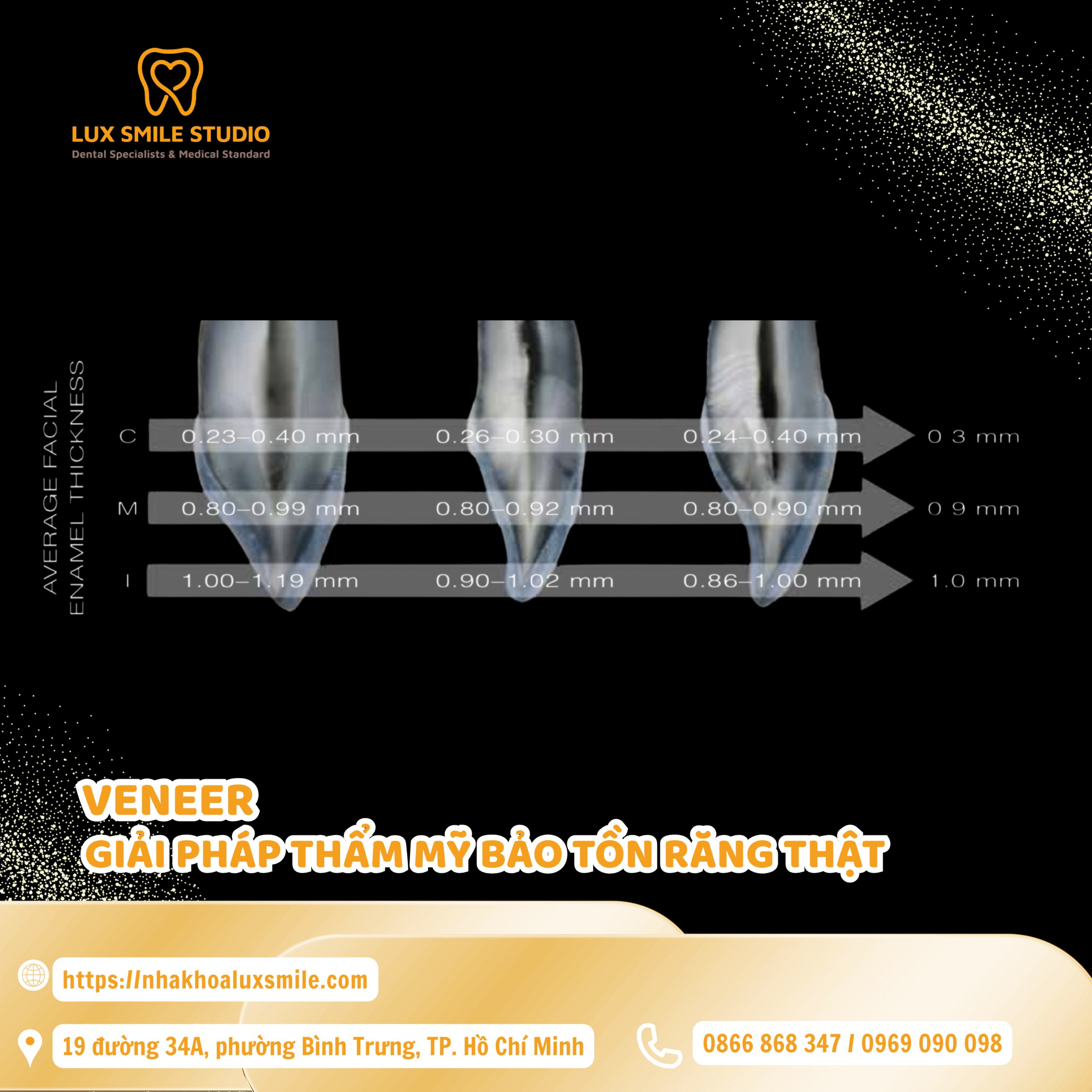 Dán sứ Veneer