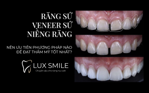 răng sứ, niềng răng, veneer